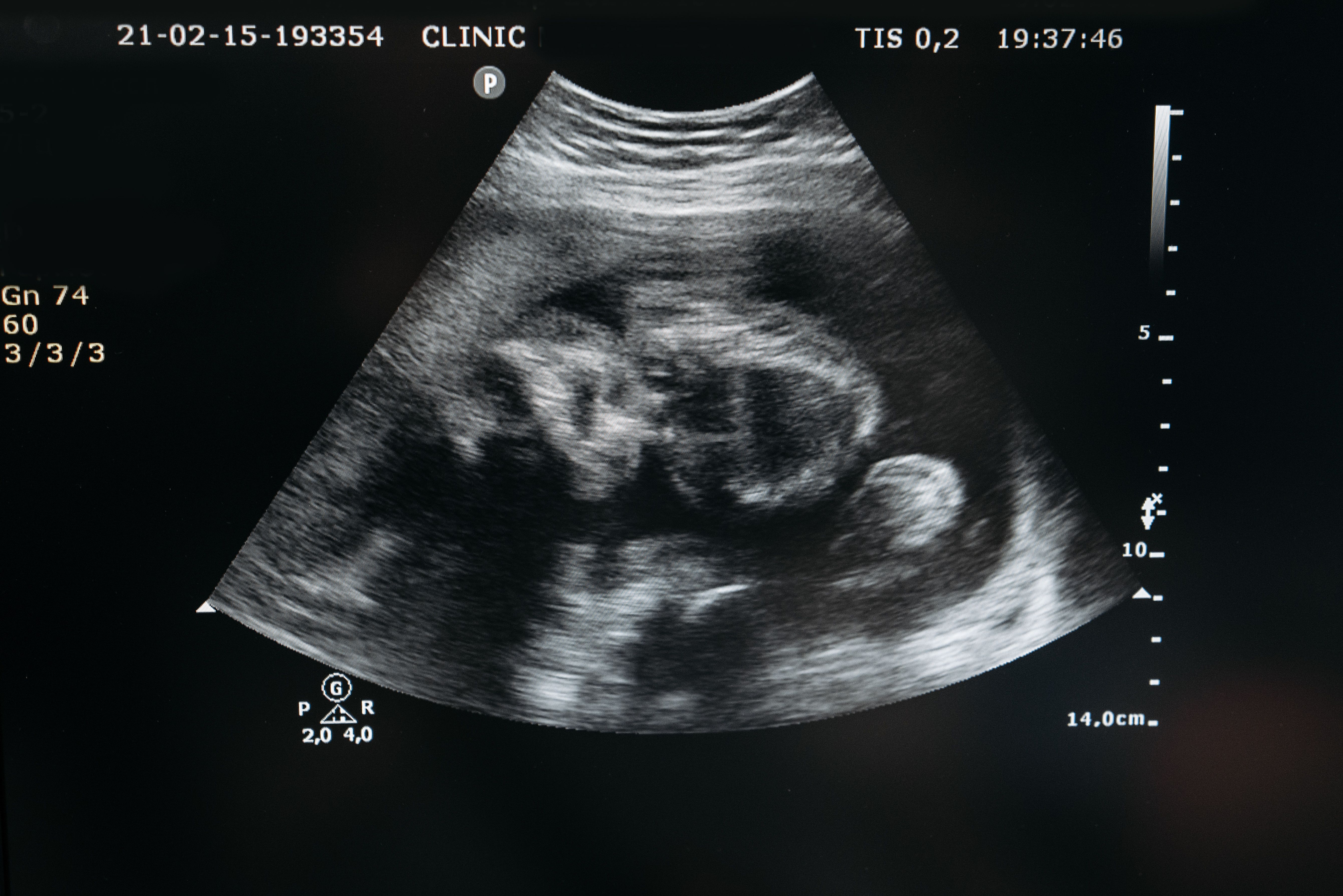 An ultrasound image of a baby before birth